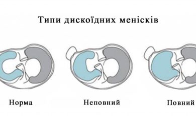 Дискоїдний меніск – вроджена аномалія менісків колінного суглоба