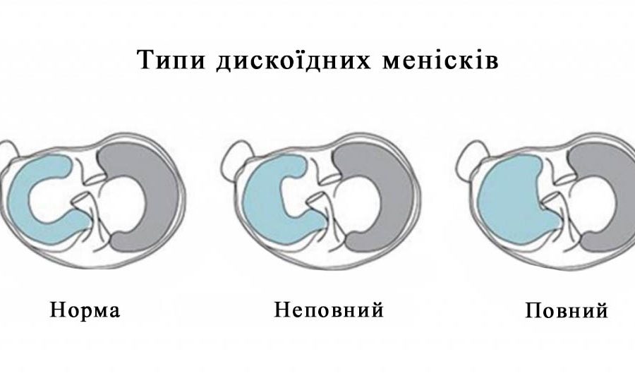 Дискоїдний меніск – вроджена аномалія менісків колінного суглоба
