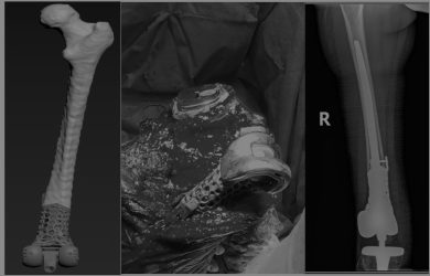 Issues of Knee Joint Endoprosthetics in Mega-defects Cases: Opportunities and Challenges